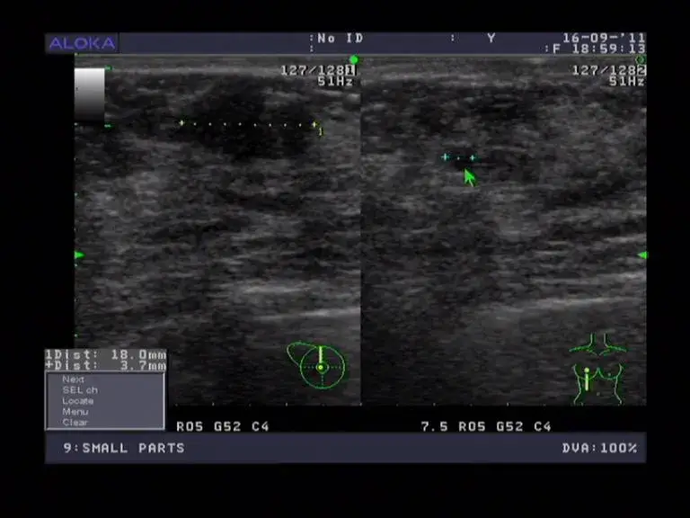 Zdjęcie USG piersi jak wygląda – wszystko o przebiegu, przygotowaniu i odczuciach pacjenta
