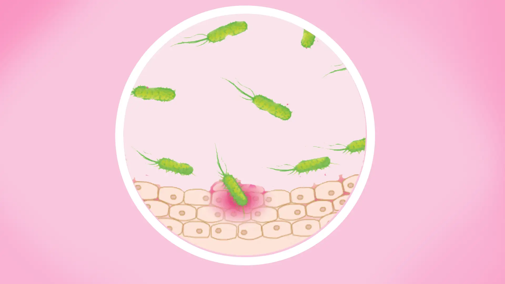 Ilustracja przedstawia bakterie Escherichia coli w moczu, atakujące kom&oacute;rki nabłonka.