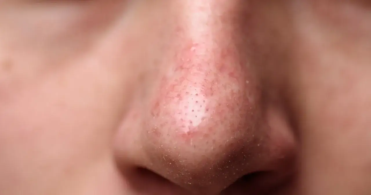 Doraźne sposoby na pryszcze