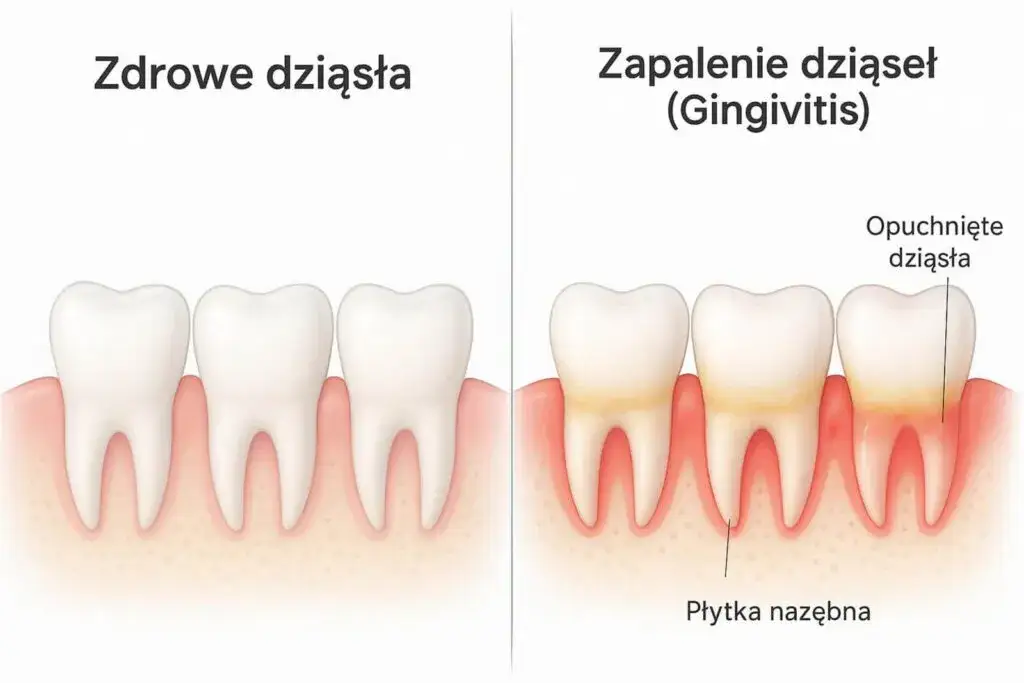 zdrowe dziąsła vs zapalenie dziąseł por&oacute;wnanie