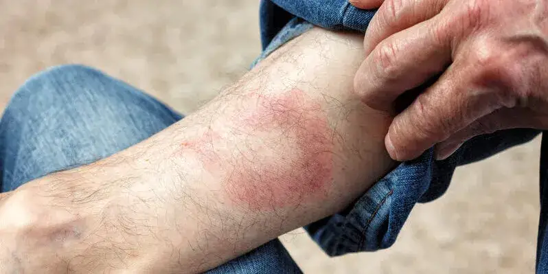 rumień wędrujący borelioza zdjęcia