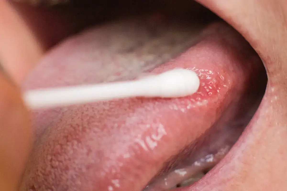 Aplikacja nystatyny dla dzieci na język z pleśniawkami. Wacik nasączony lekiem dotyka zaczerwienionego obszaru.