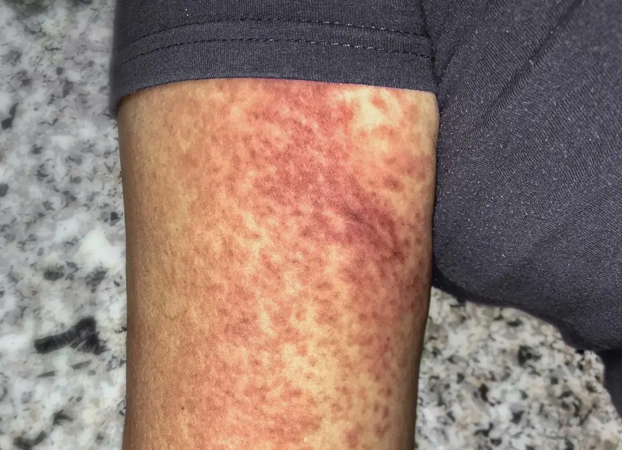 Plamy na sk&oacute;rze mogą być objawem sepsy. Szybkość rozwoju sepsy jest zmienna, ale ważne jest szybkie rozpoznanie.