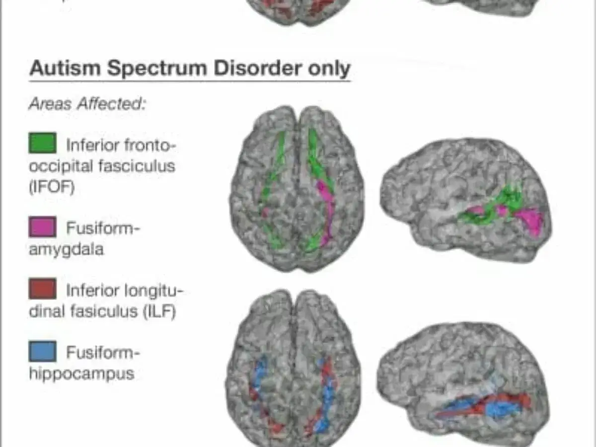 M&oacute;zg autystyczny: obszary dotknięte zaburzeniem, w tym inferior fronto-occipital fasciculus (IFOF) i fusiform-amygdala.