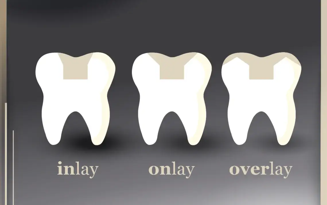 inlay onlay dentystyka por&oacute;wnanie