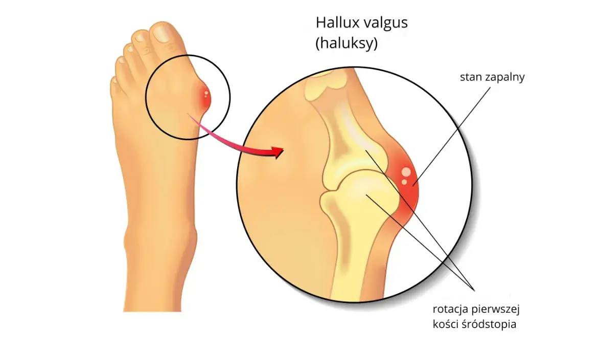Anatomia stopy haluksy, paluch koślawy, budowa stopy, prawidłowa stopa