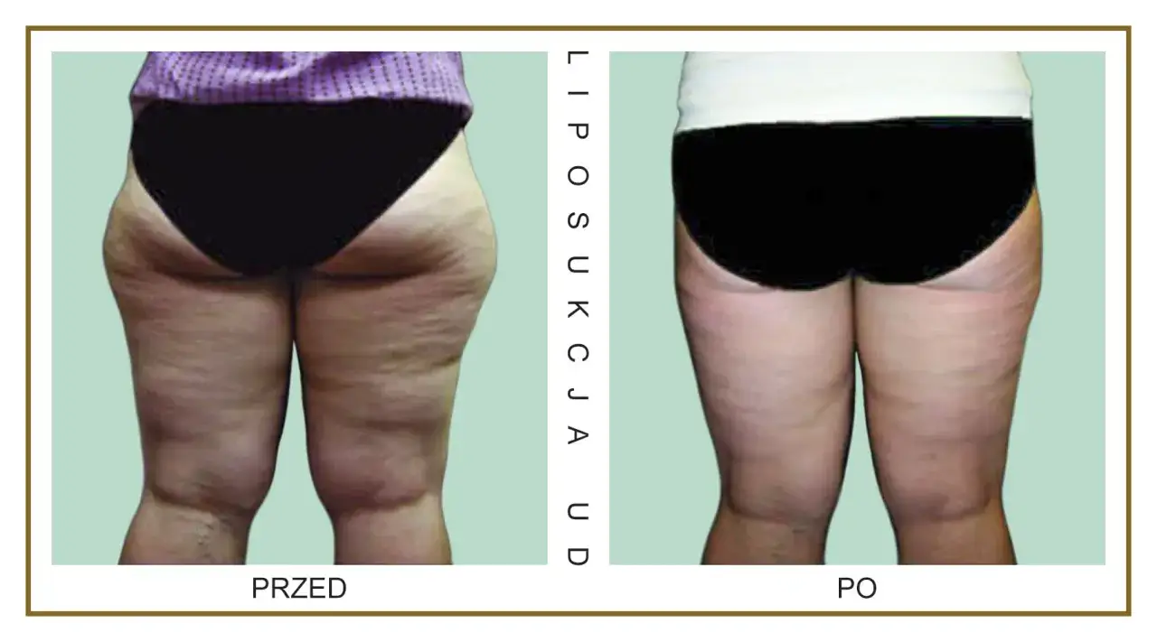 Rodzaje liposukcji porównanie