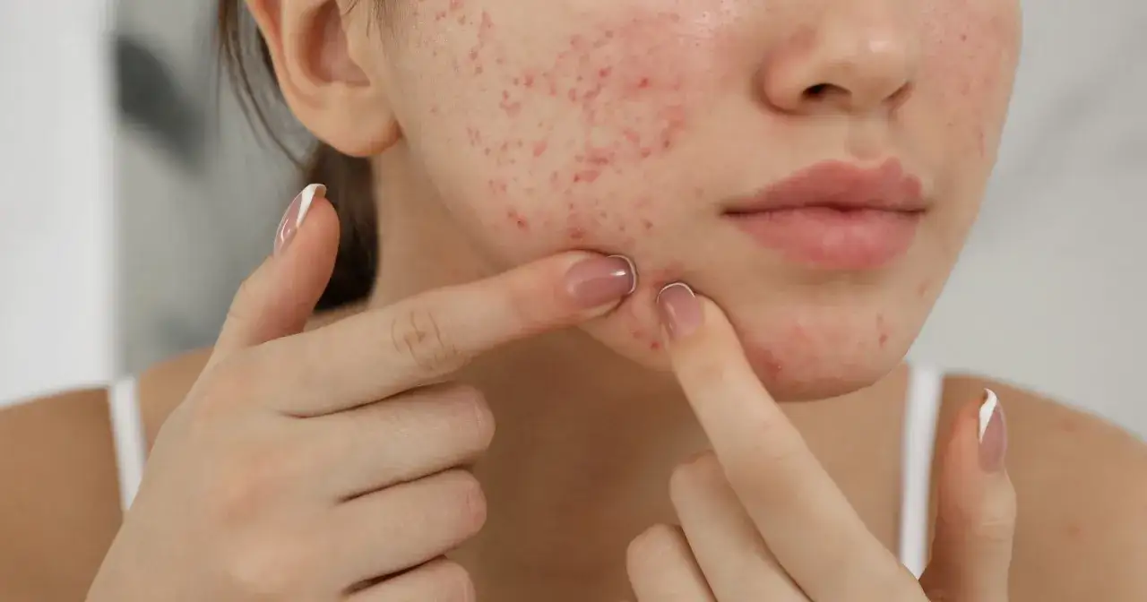 Szybkie sposoby na pryszcze przed wyjściem, plastry na wypryski