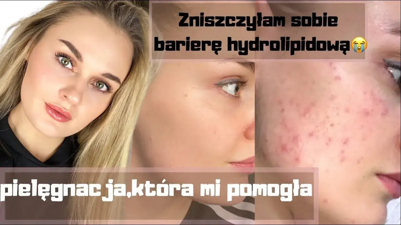 skóra trądzikowa bariera hydrolipidowa