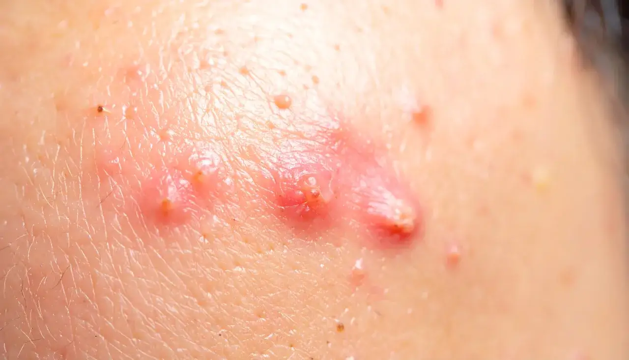 Zbliżenie na skórę pokazujące, jak wygląda pryszcz: zaczerwienione, wypukłe zmiany z widocznymi białymi czubkami i drobnymi włoskami.