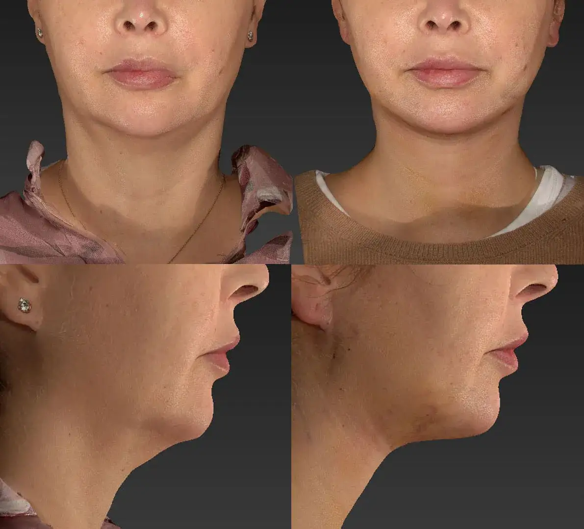 Zdjęcie Ile kosztuje liposukcja podbródka? Ceny i ukryte wydatki, które musisz znać