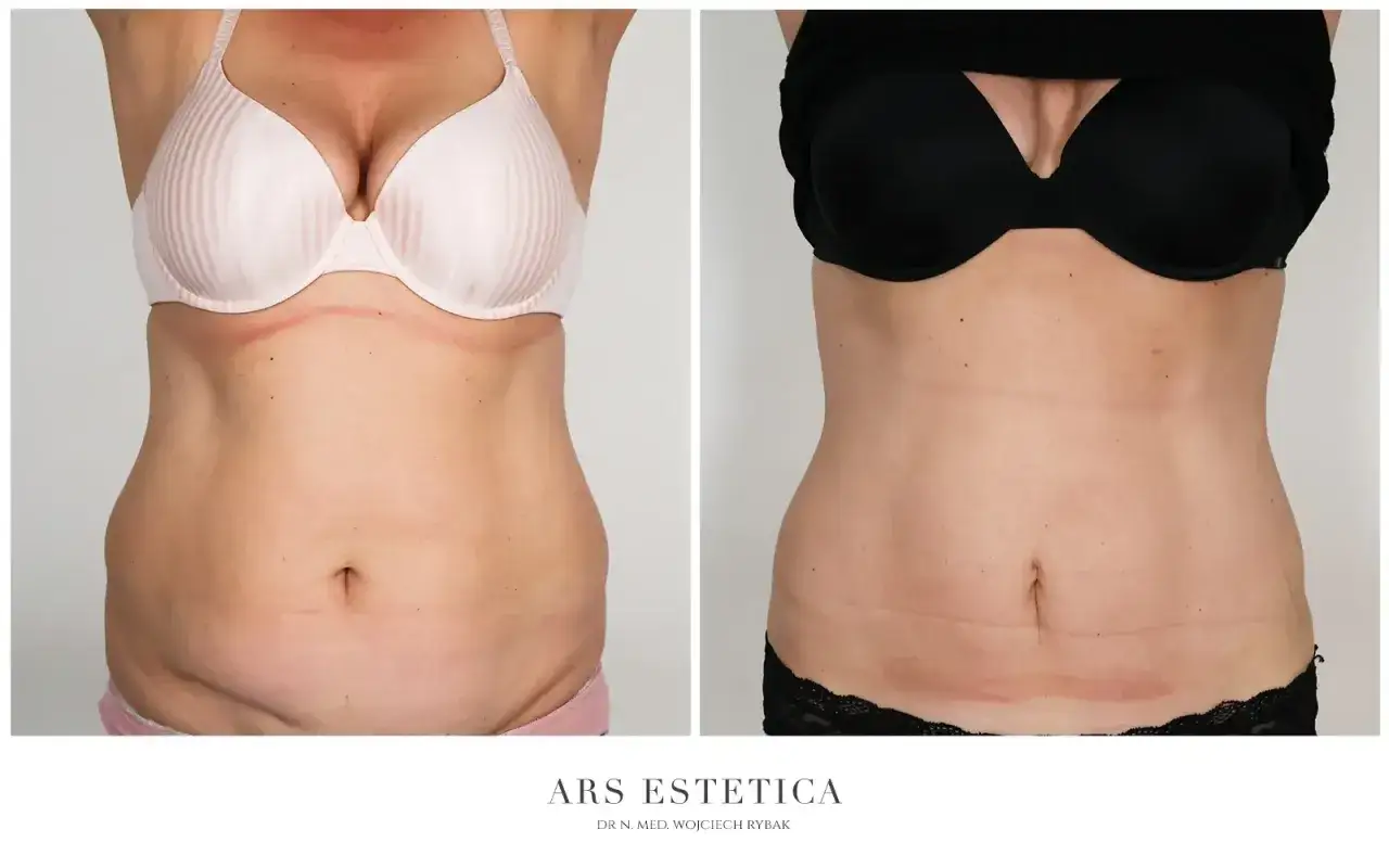 Spektakularne liposukcja brzucha efekty. Por&oacute;wnanie sylwetki przed i po zabiegu. Wygładzony brzuch, wyraźniejsze kontury.