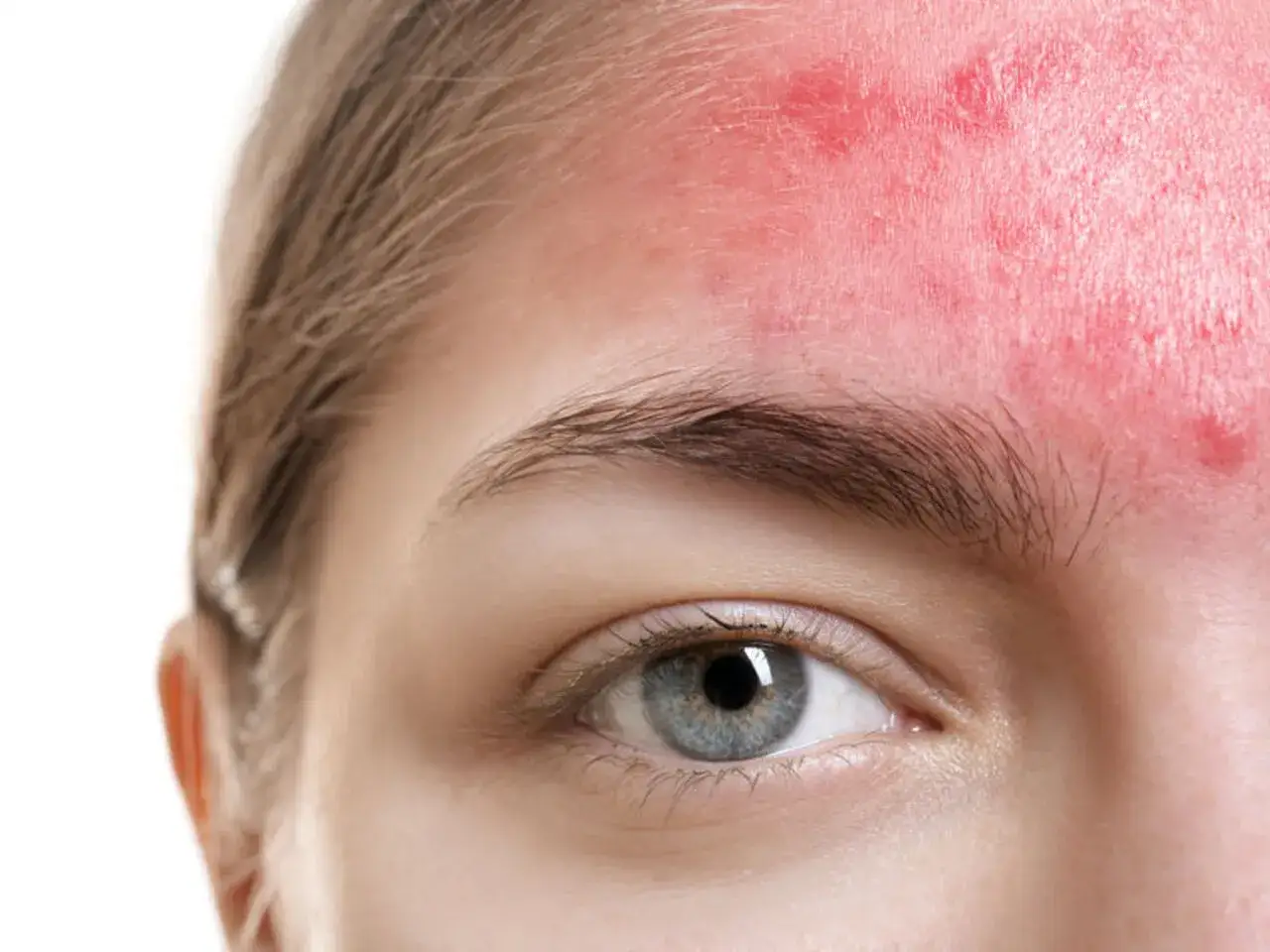 osoba z pryszczem na twarzy, zmartwiona