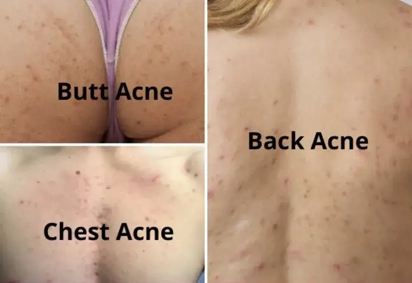 sk&oacute;ra plec&oacute;w z trądzikiem i bez por&oacute;wnanie