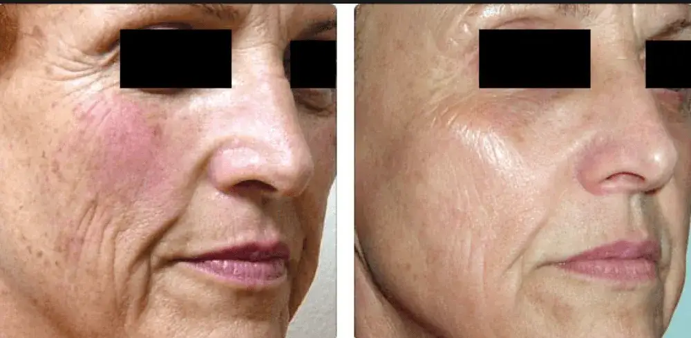 Zdjęcie Jak często stosować laser frakcyjny, aby uniknąć rozczarowania?