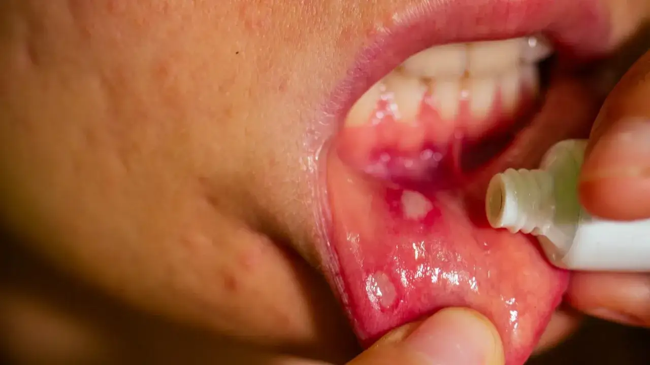 Afta w buzi. Ranka na wewnętrznej stronie policzka, na kt&oacute;rą nakładana jest maść.