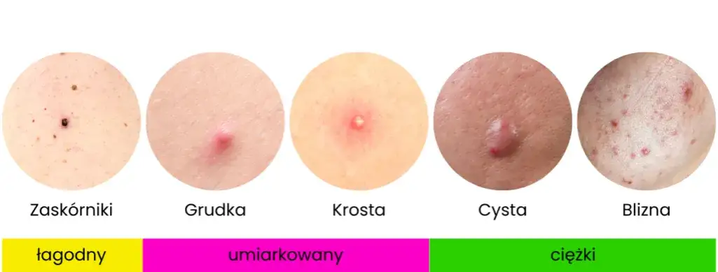 Różne typy zmian skórnych trądzikowych i ich wygląd