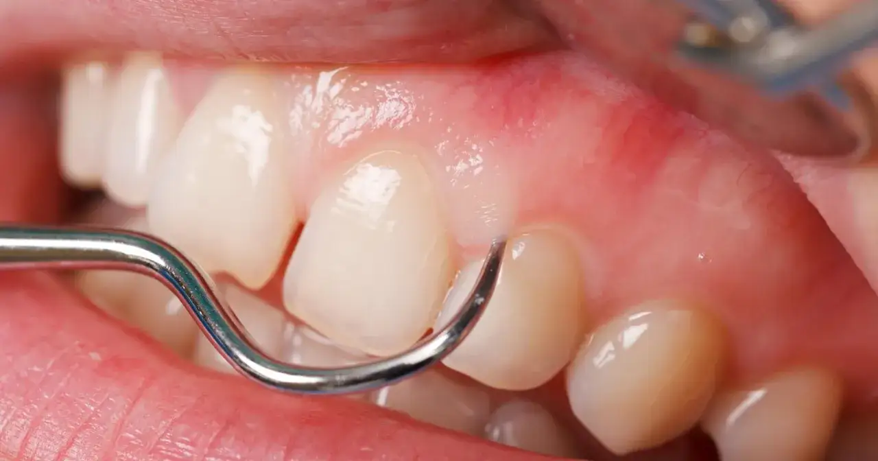 Dentysta bada ząb, delikatnie dotykając dziąsła narzędziem. Widoczna jest mała, błyszcząca gula na dziąśle, która może wymagać uwagi.