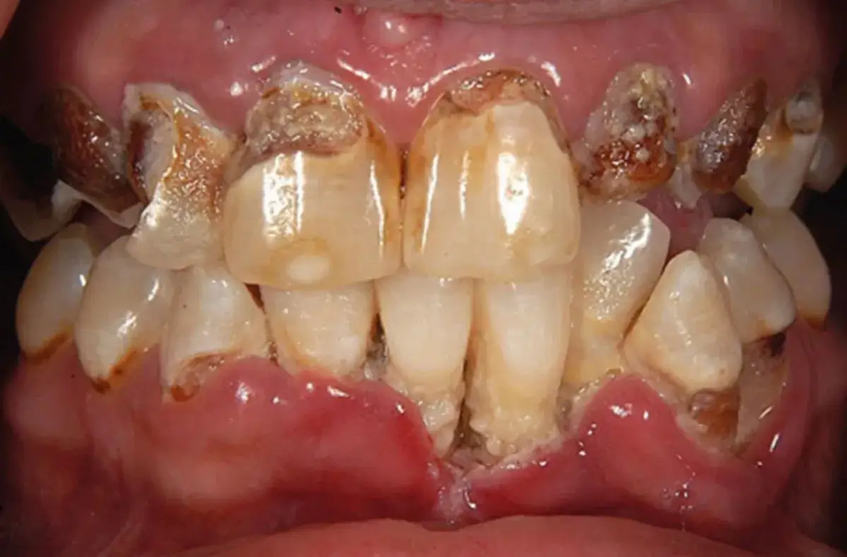Meth mouth zęby zniszczone metamfetamina