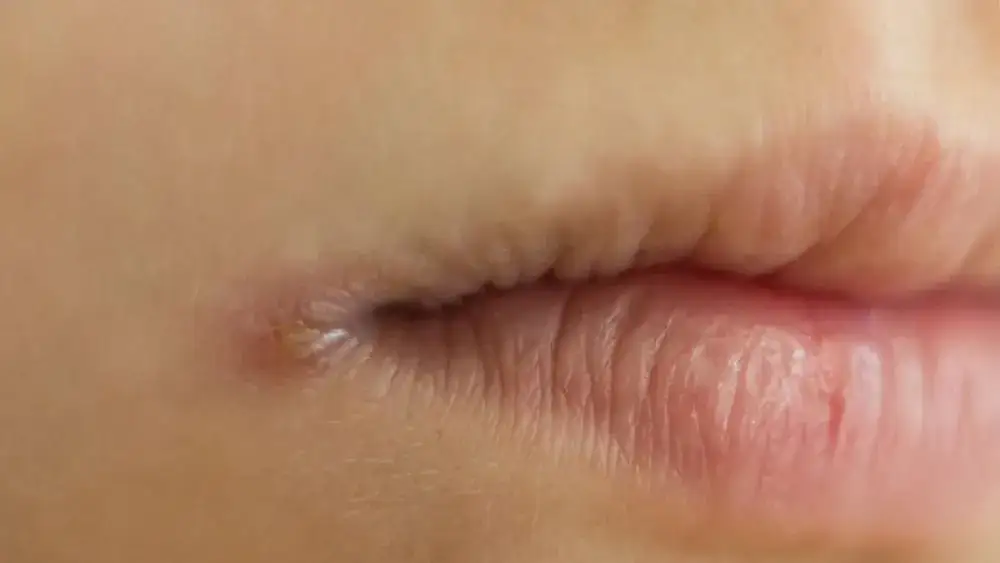 Pękające kąciki ust zajady niedobór witamin