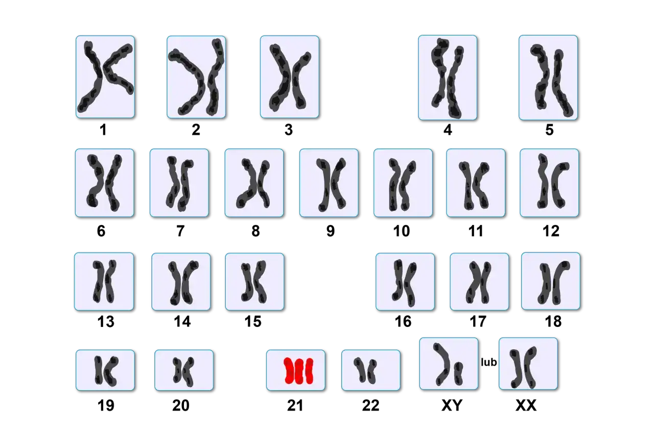 Rodzaje mutacji chromosomowych zesp&oacute;ł Downa