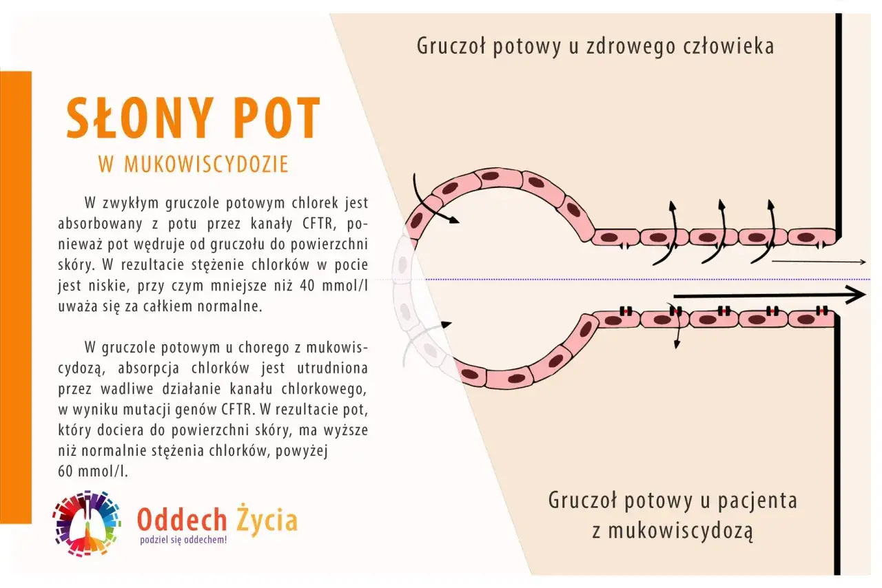 niemowlę słony pot