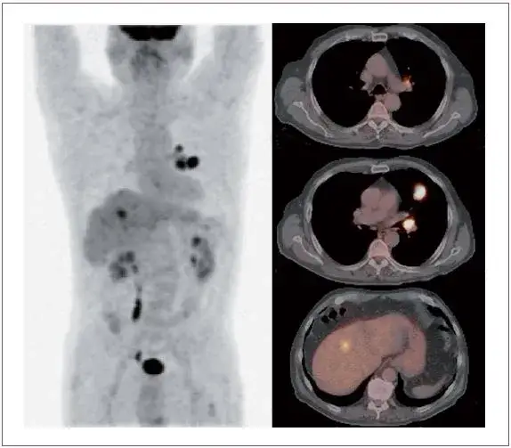 PET-CT skan wykrywanie przerzutów