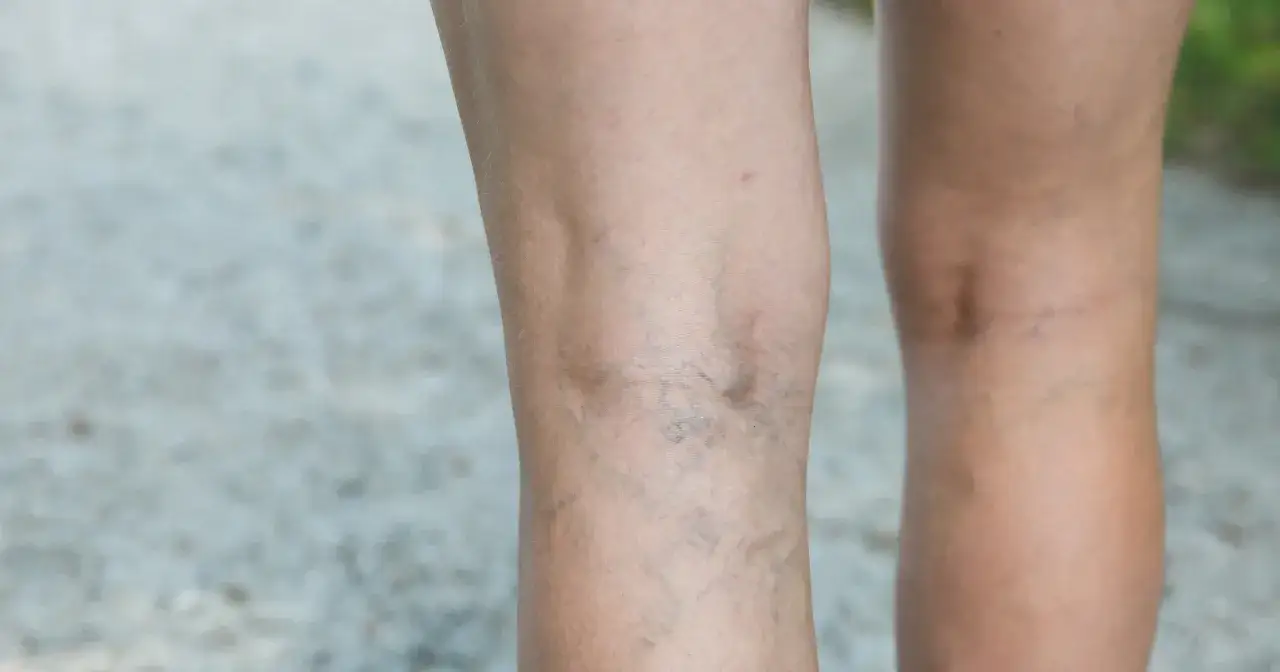 Widoczne pajęczynki naczyniowe na nogach. Dowiedz się, jak wzmocnić naczynia krwionośne i poprawić ich wygląd.