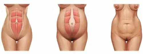 Anatomia brzucha po cesarskim cięciu schemat