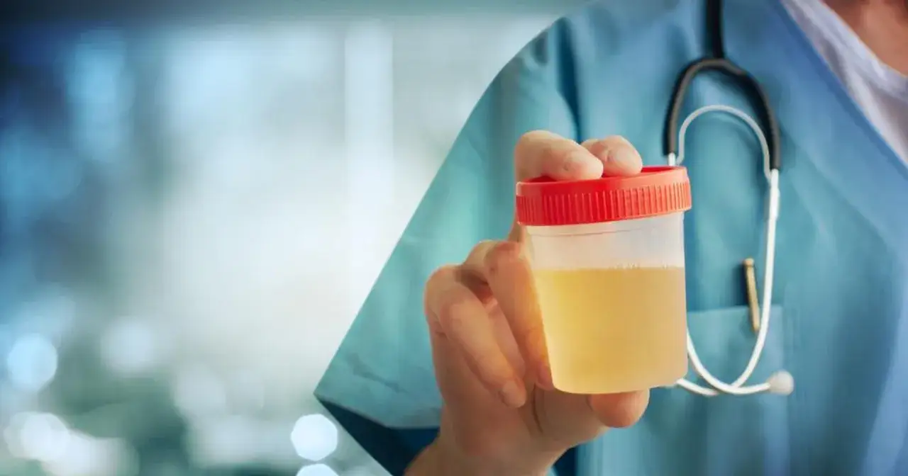 Lekarz trzyma pojemnik z pr&oacute;bką moczu, gdzie widoczne są leukocyty w moczu 30-50.