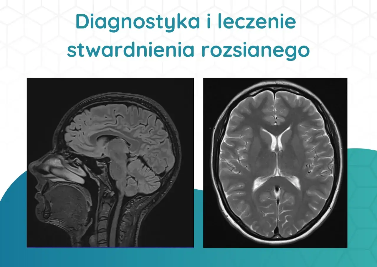 Diagnostyka stwardnienia rozsianego MRI