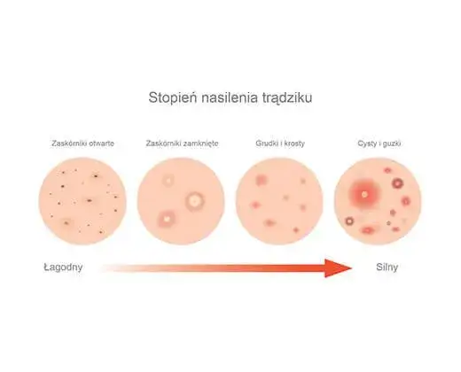 r&oacute;żne typy trądziku na twarzy i ich lokalizacja