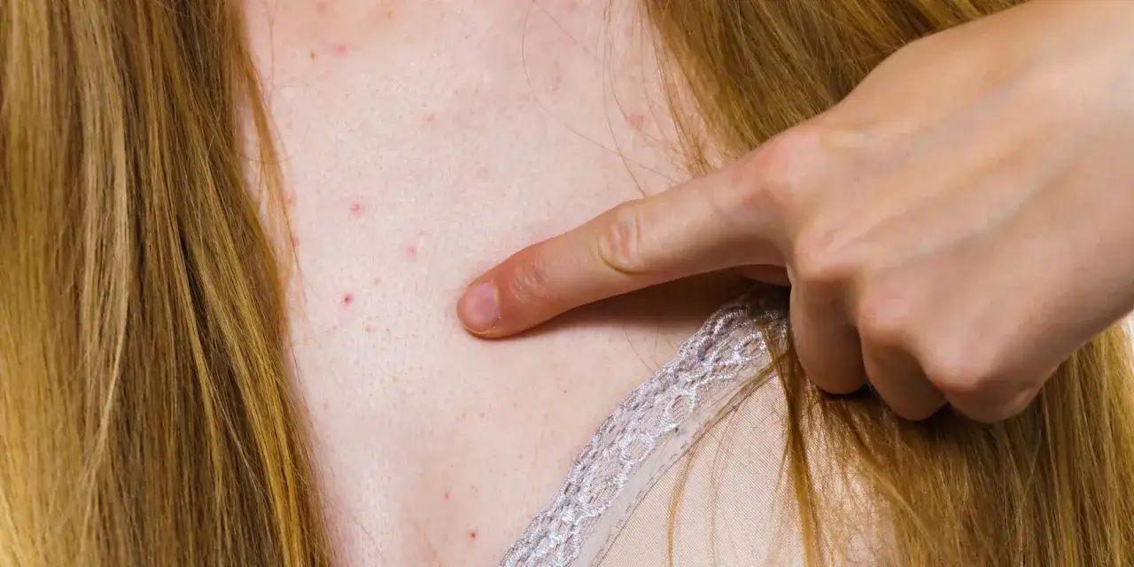 pryszcze na dekolcie przyczyny