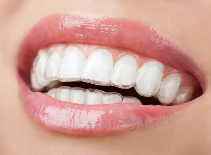 porównanie aparatu ortodontycznego i nakładek Invisalign