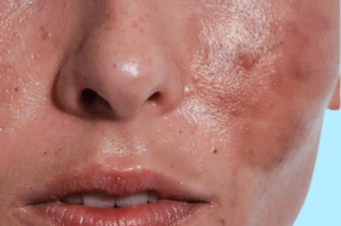 składniki aktywne na przebarwienia pozapalne