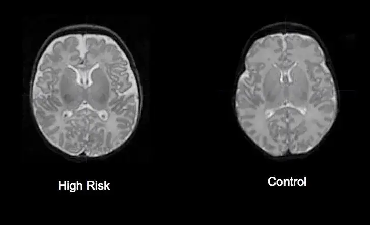 różnice w mózgu schizofrenia rezonans