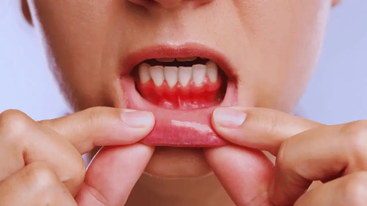 Osoba pokazuje zaczerwienione dziąsła, sugerując problem, który może wymagać interwencji, by co wyciąga ropę z zęba.