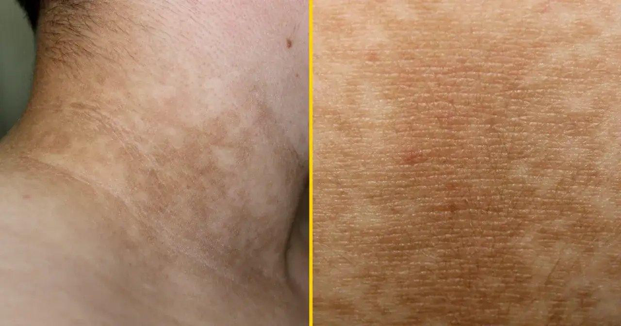 rogowacenie ciemne acanthosis nigricans