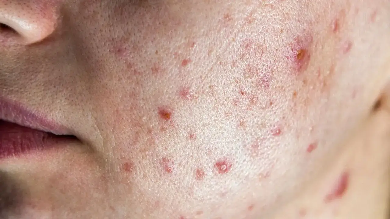 Rodzaje pryszczy i ich wygląd