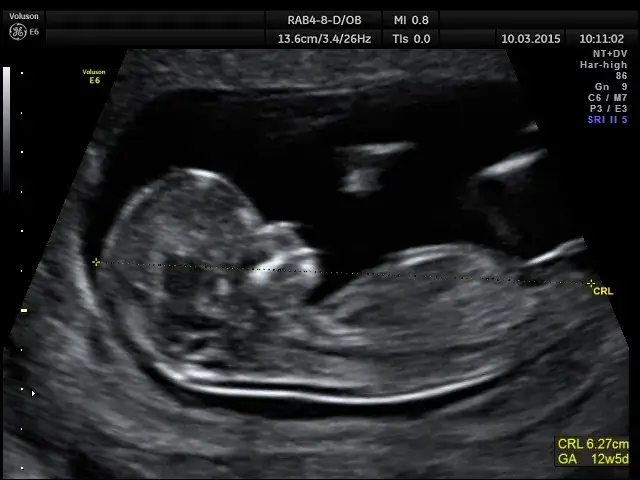 USG ciąży pierwszy trymestr, pomiar CRL