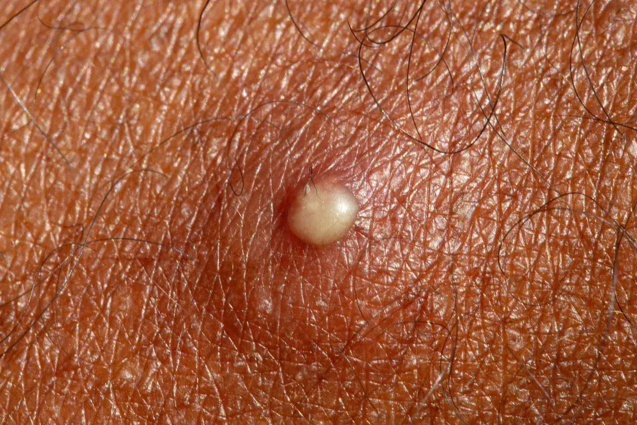 Zbliżenie na skórę, gdzie widać, jak wygląda pryszcz: mała, biała grudka z włoskami wokół.