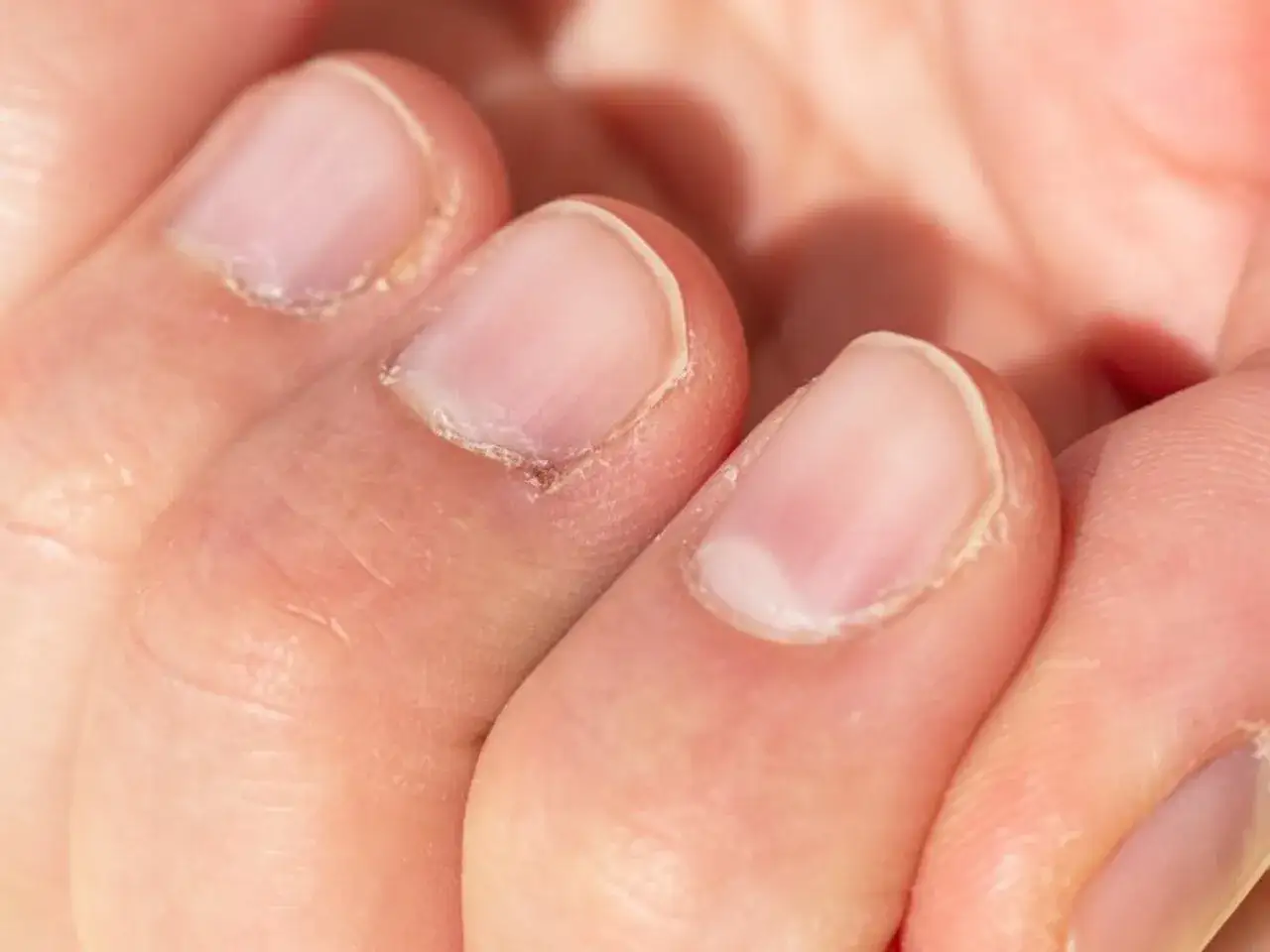 Zbliżenie na palce dłoni z widocznymi pękającymi skórkami przy paznokciach. Skóra wokół paznokci jest sucha i lekko zaczerwieniona.