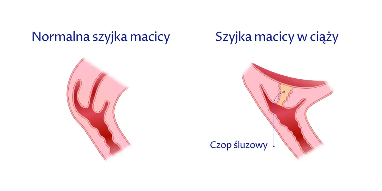 proces skracania szyjki macicy grafika