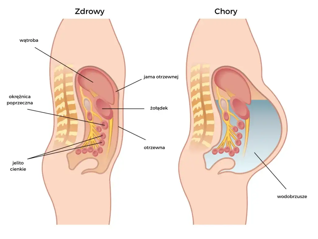 Zdjęcie Guz wątroby objawy: jak rozpoznać niebezpieczne symptomy?