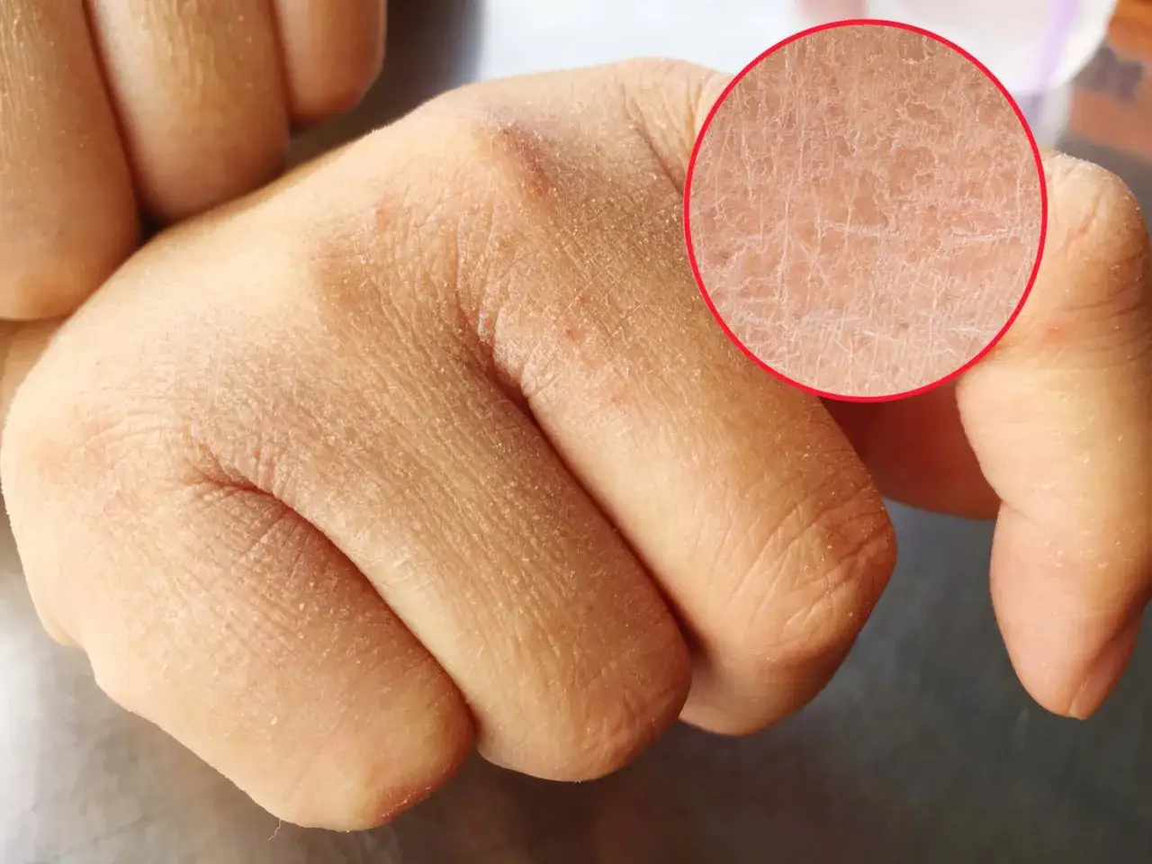 Suchy, popękany naskórek na dłoniach, z widocznym powiększeniem ukazującym drobne pęknięcia. Mogą to być plamy na skórze od wątroby.