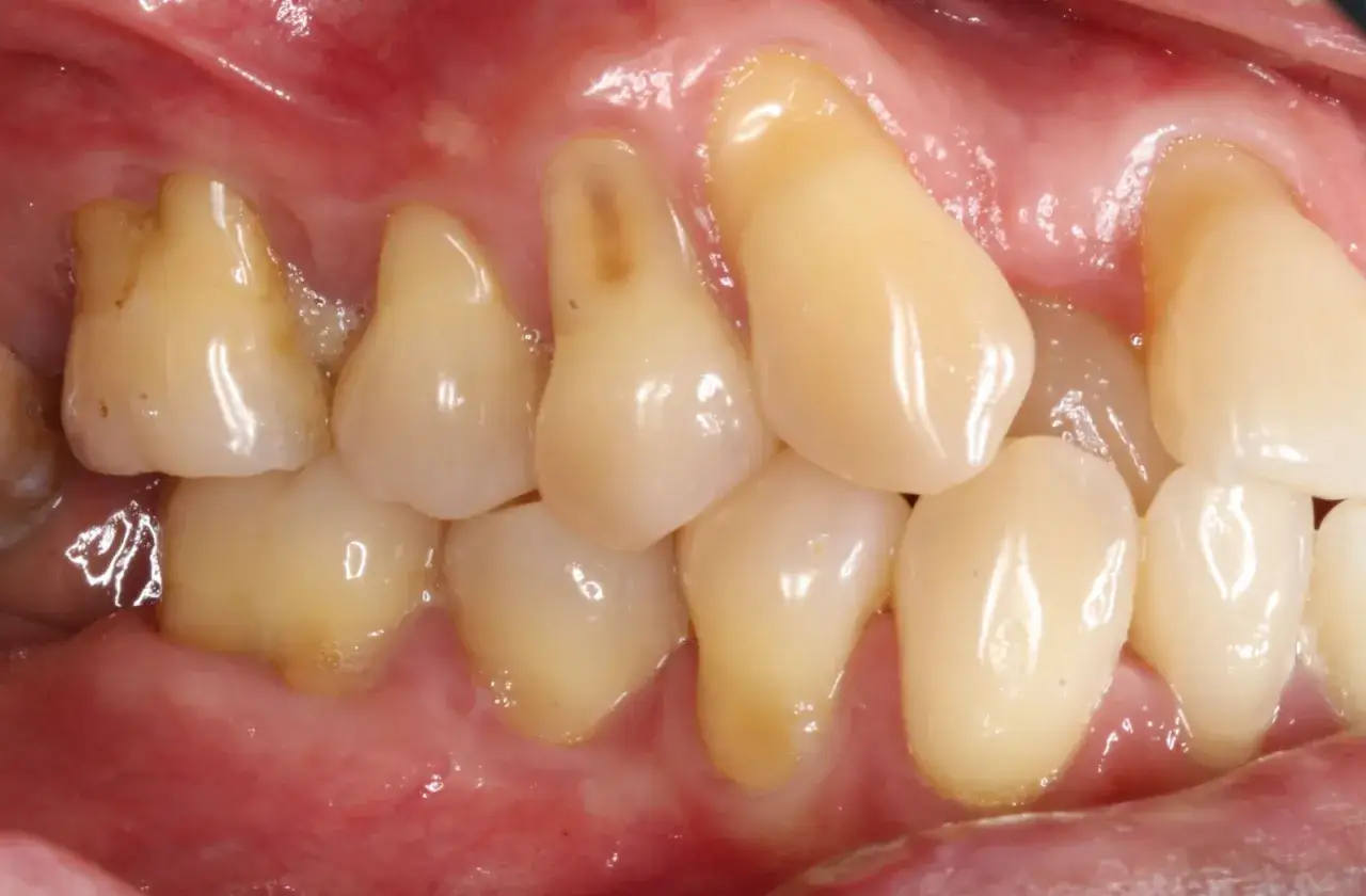 Widoczne zęby z widocznym cofaniem się dziąseł, odsłaniającym szyjki zębowe.