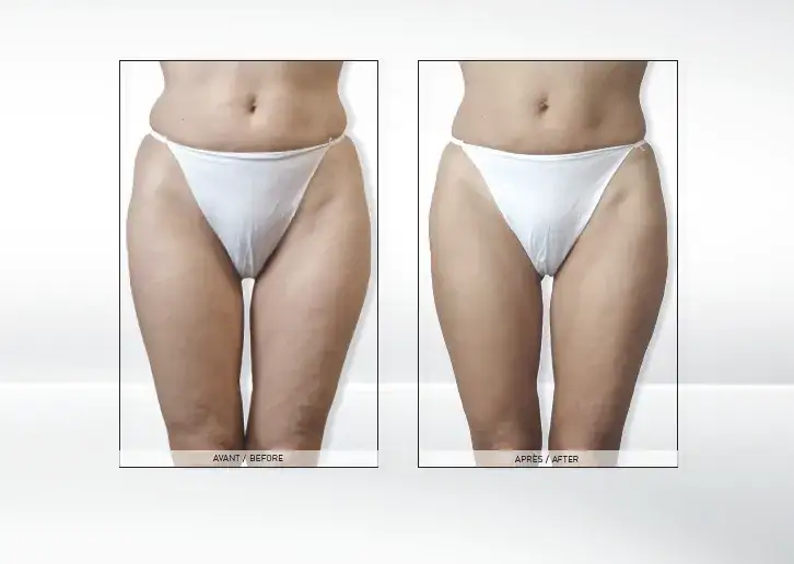 por&oacute;wnanie endermologia karboksyterapia drenaż limfatyczny