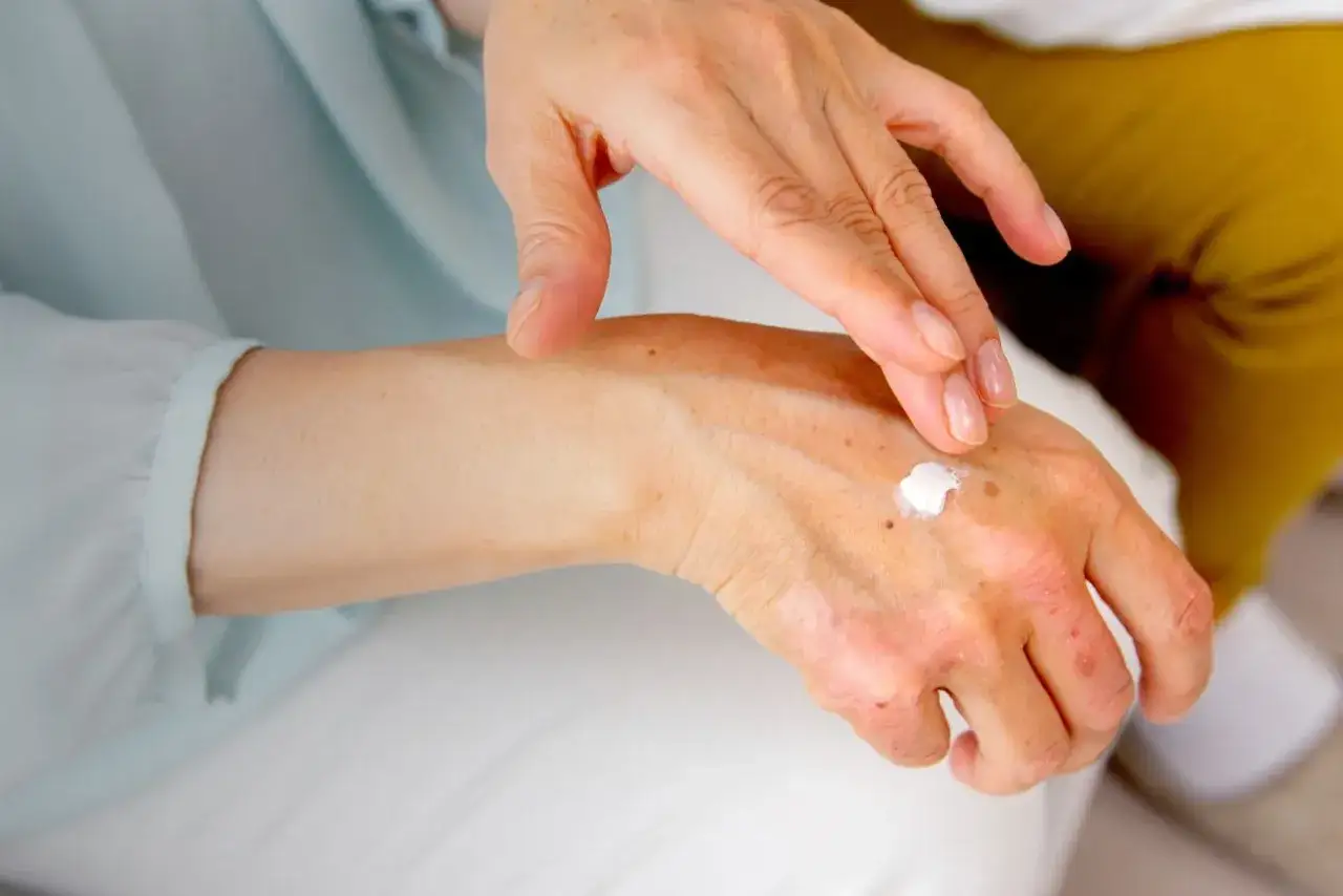 Dłoń z widocznymi przebarwieniami i zolte plamy na dloni. Kobieta aplikuje krem.