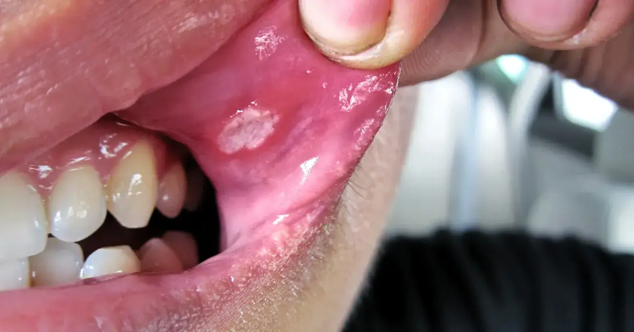 Biała, bolesna zmiana w jamie ustnej, która może być oznaką, od czego powstają afty. Widoczne zęby i zaczerwienione dziąsła.