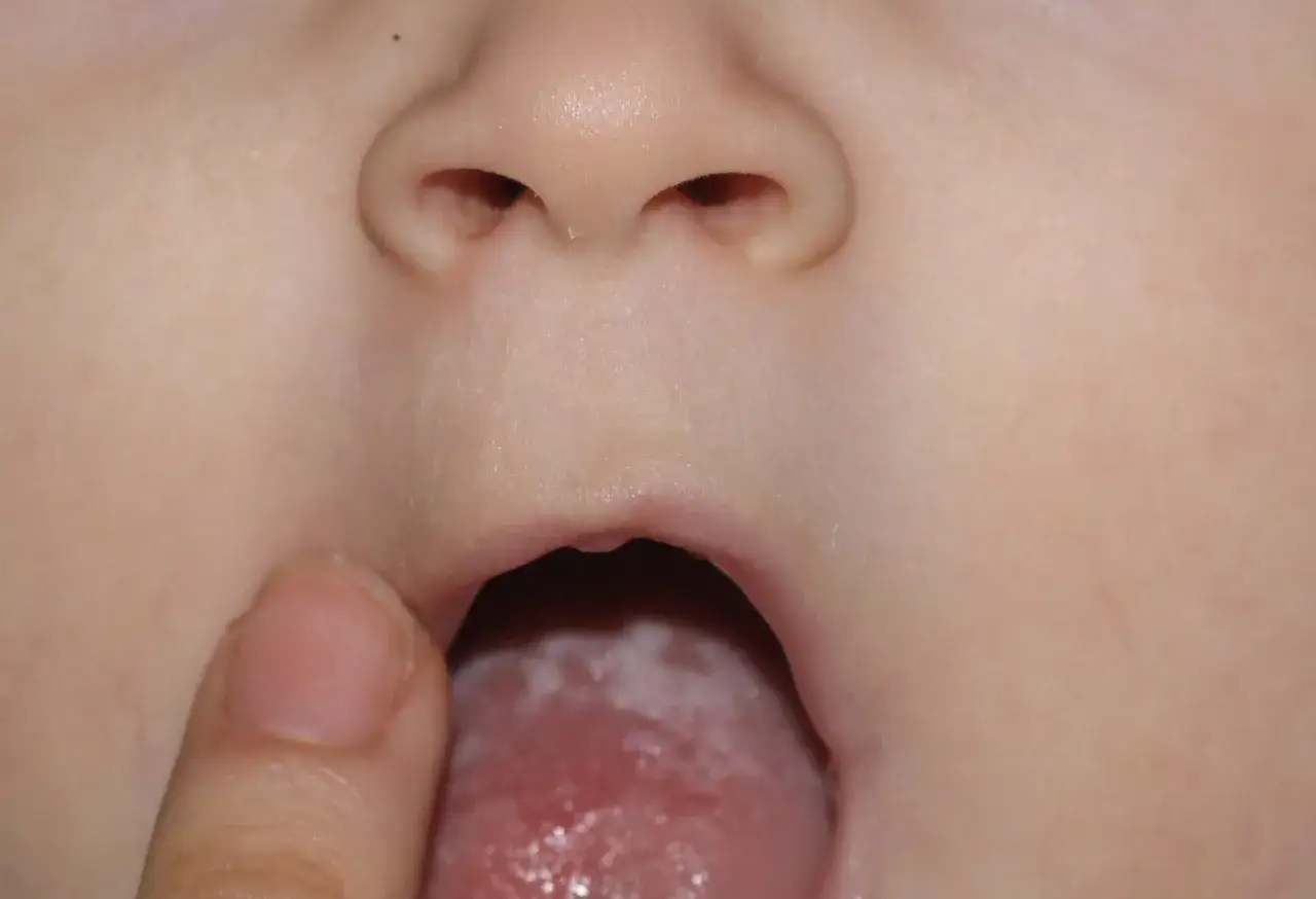 Język niemowlaka pokryty białym nalotem, wskazującym na pleśniawki. Widoczny fragment noska i ust.